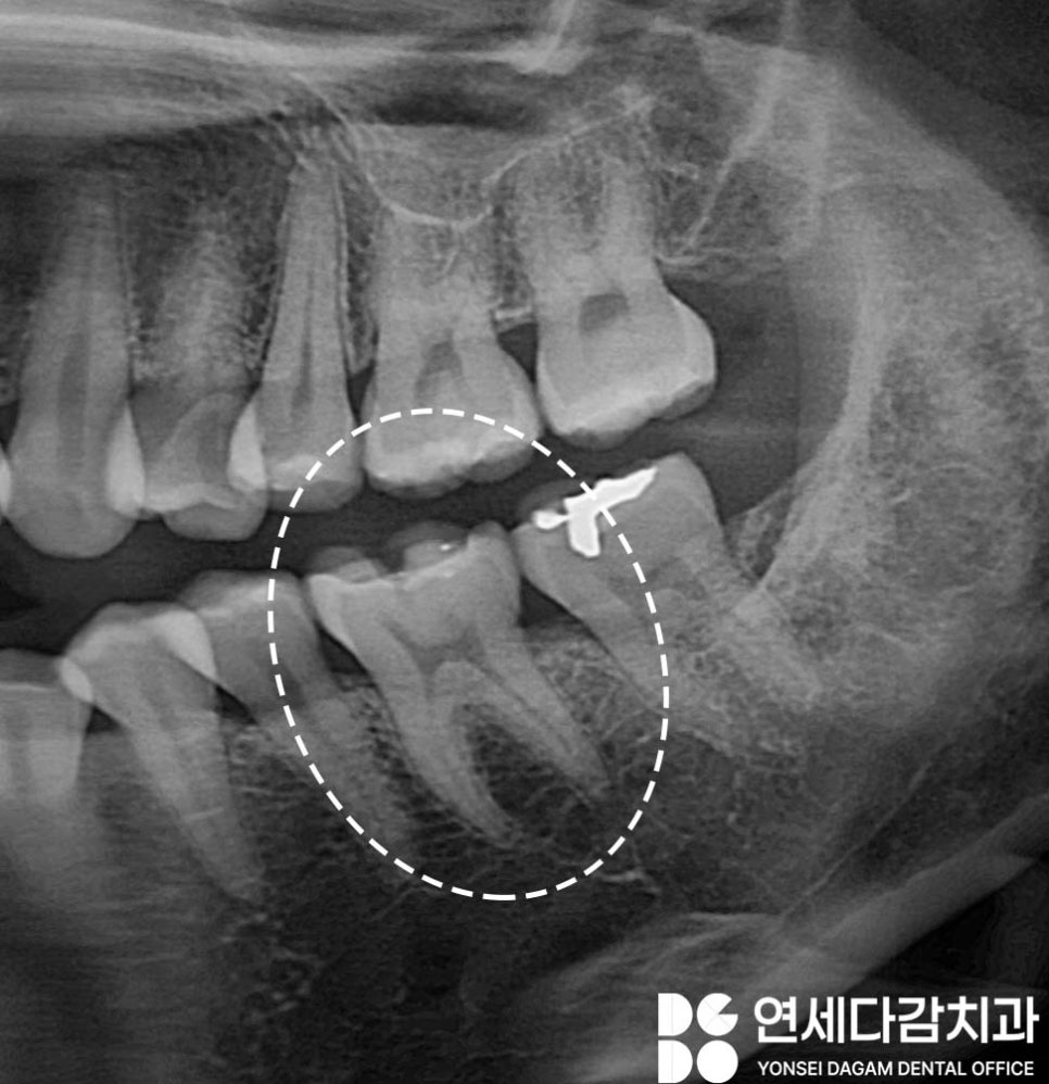 오금역 치과 어금니 골드 인레이 떨어짐 재치료 꼭 필요할까 탈락한 원인 파악이 중요한 이유와 보철 종류 특징 관련 이미지 2