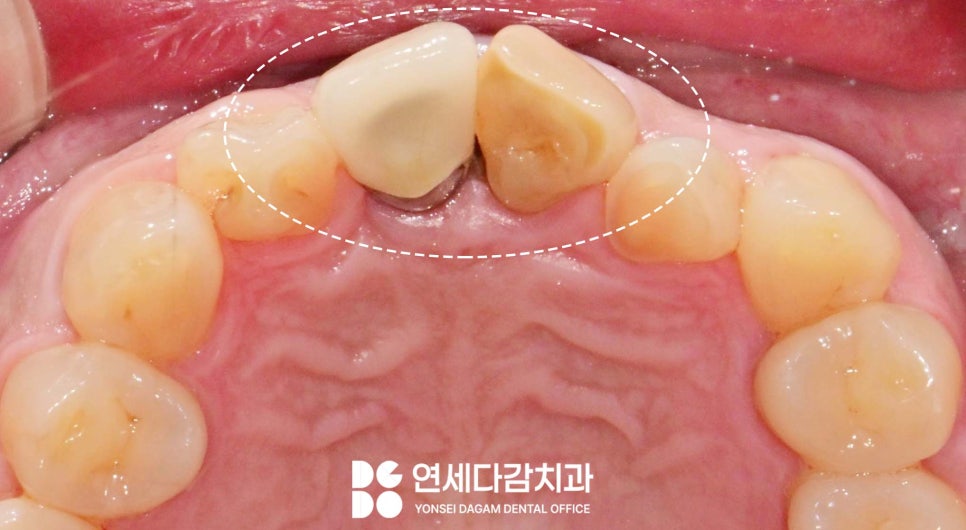 앞니 벌어짐 거여동 치과 치은성형술 동반하여 교정 없이 크라운 교체 및 최소삭제 라미네이트 통한 심미 치료 관련 이미지 3