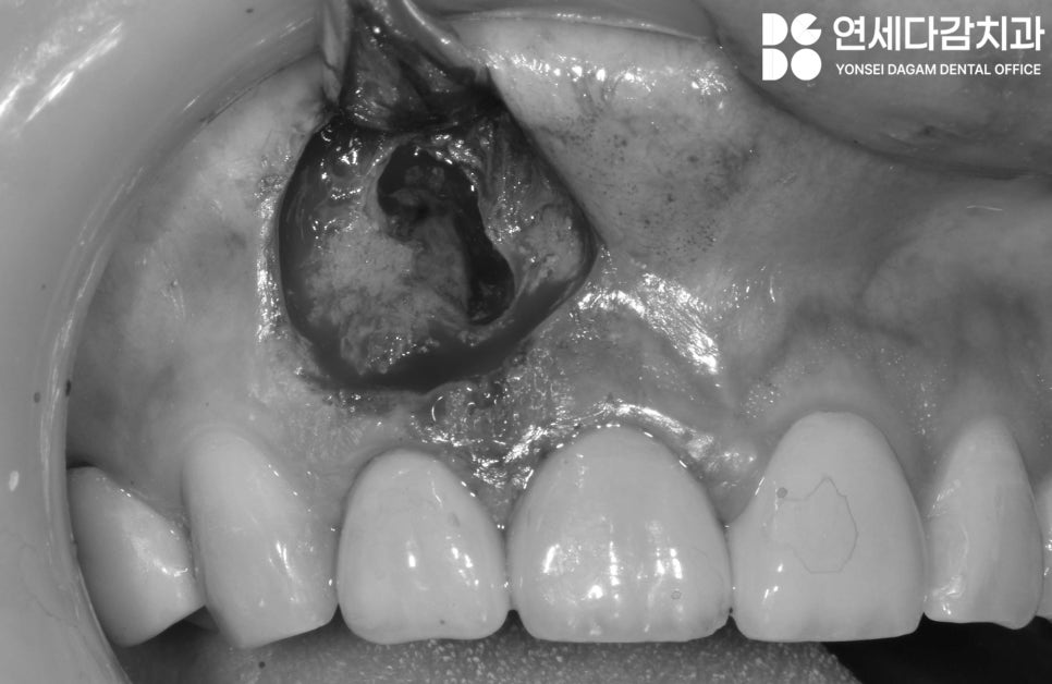 치아 발치를 피하기 위한 마지막 수단 MTA 이용한 가락동 치과 치근단 절제술 과정 살펴봅시다. 관련 이미지 4