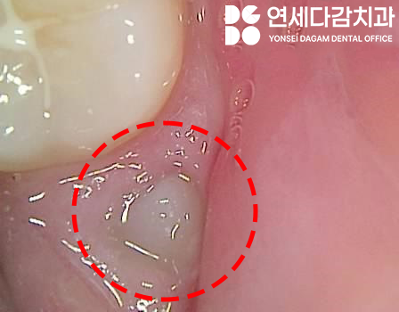 매복 사랑니 옆에 또 다른 치아 이것은 무엇일까요 송파구 가락동 치과 에서 알려드리겠습니다. 관련 이미지 2