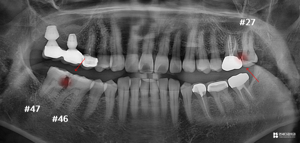 개롱역치과 아프기 전에 발견해야 되는 이유 인접면 충치 치료 관련 이미지 3
