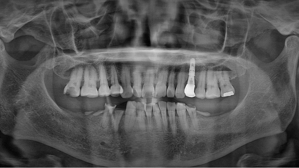 Munjeong-dong Dental Clinic, Bone Graft Implant Process&middot; What If You’ve Lost a Molar? image 12