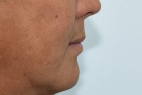 Munjeong-dong Full-Mouth Dental Implants: Why Did the Patient’s Appearance Change After Simply Replacing the Teeth? image 10