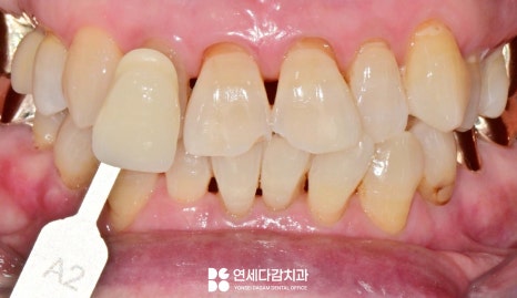 거여동 치과 전문가 치아 미백 원리와 올바른 관리 방법 알아봅시다. 관련 이미지 3