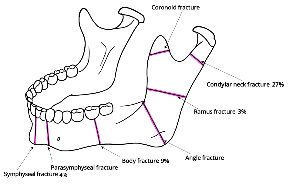 문정역 치과 에서 알아보는 턱뼈 골절 됐을 때 악간고정술 치료 같이 진행하는 이유 관련 이미지 1