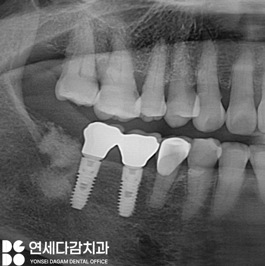 오래된 임플란트 다시 수술하지 않고 크라운 교체만 가능할까 문정동 치과 SCRP 타입으로 보철 재제작 관련 이미지 2