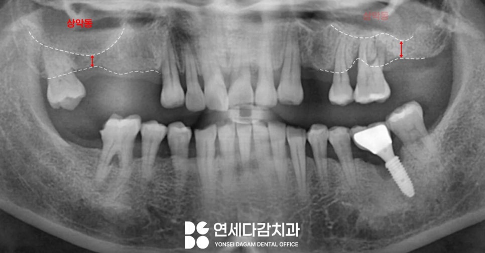뼈가 부족해도 상악동 거상술을 통한 문정동 치과 뼈이식 임플란트 과정 관련 이미지 1