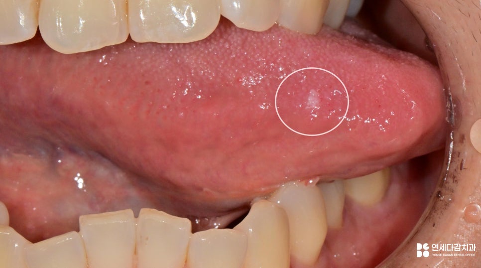 개롱역 치과 혀에 하얀 돌기? 구강 유두종 작아도 조직검사가 필요한 이유 관련 이미지 3