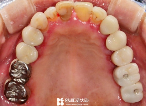 잇몸이 붓고 피나고 냄새날 때 송파역 치과 구강암 증상과 비슷한 급성 궤양성 치은염 (ANUG) 잇몸치료 통한 치주질환 개선 관련 이미지 4