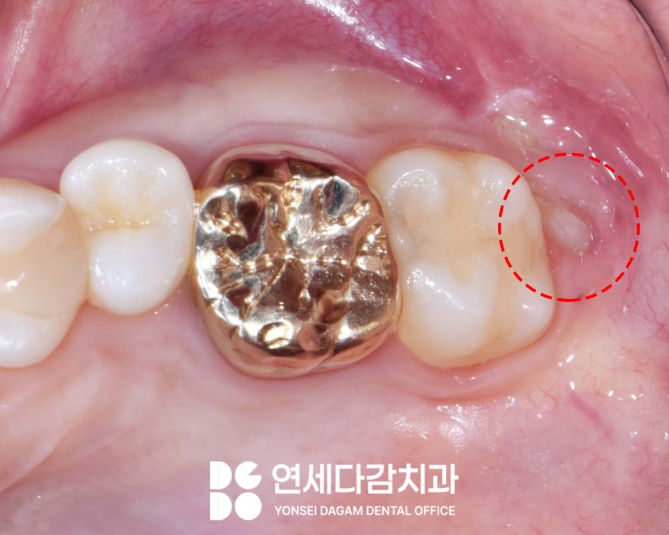 매복 사랑니 발치 시 관련 이미지 2