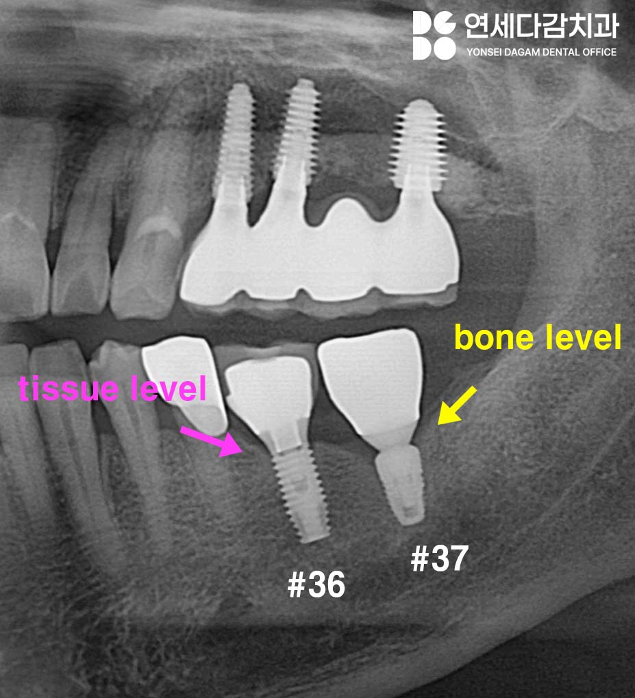 개롱역 치과 오스템 임플란트 종류의 다양성과 형태 구분법, 이것을 이용한 재수술 없는 보철 치료 관련 이미지 2