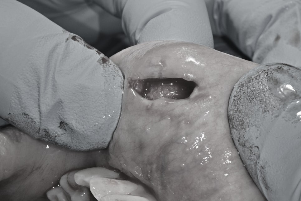 Geoyeo Station Dental Clinic, Mucous Cyst Removal&middot;What If a Lump-Like Bump Protrudes Inside Your Mouth? image 6