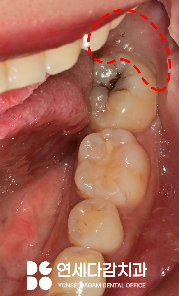 거여역 치과 공포증 수면마취 (의식하진정) 통해 매복 사랑니 발치 및 충치 치료 극복할 수 있습니다. 관련 이미지 2