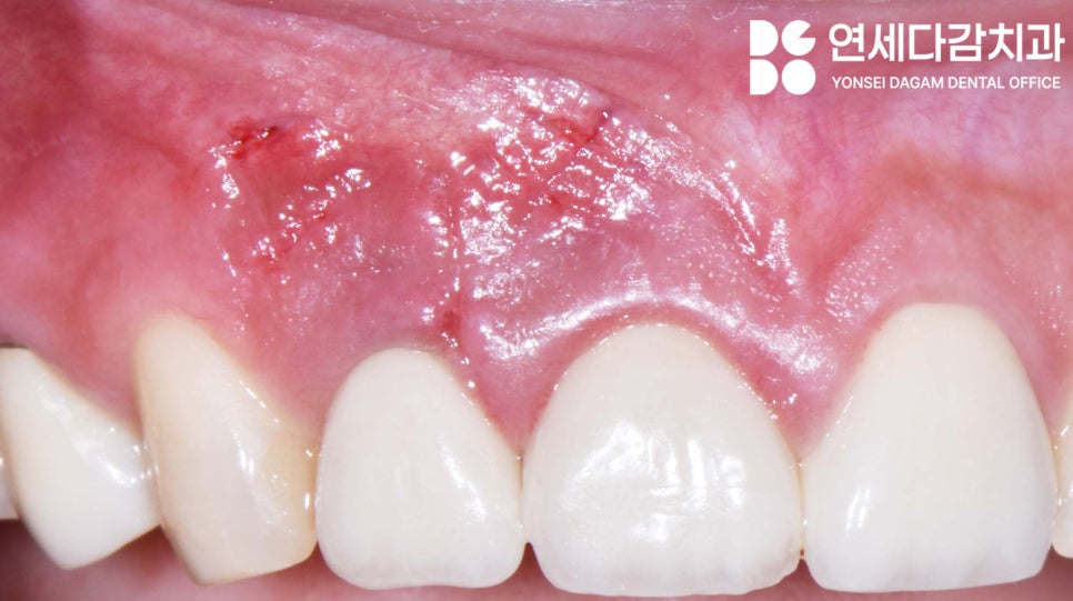 치아 발치를 피하기 위한 마지막 수단 MTA 이용한 가락동 치과 치근단 절제술 과정 살펴봅시다. 관련 이미지 7