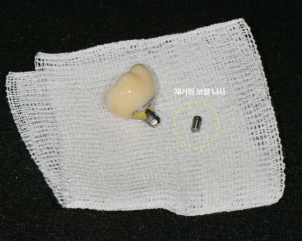 임플란트 빠짐 또는 흔들림 거여역 치과 나사 부러지고 빠졌을 때 재수술 없이 보철 크라운 교체할 수 있는 방법 관련 이미지 7