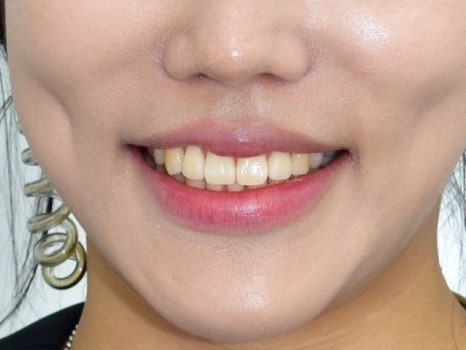 연세다감치과의 치아 깍지 않는 무삭제 라미네이트 (시술 후 변화와 관리법) 관련 이미지 5