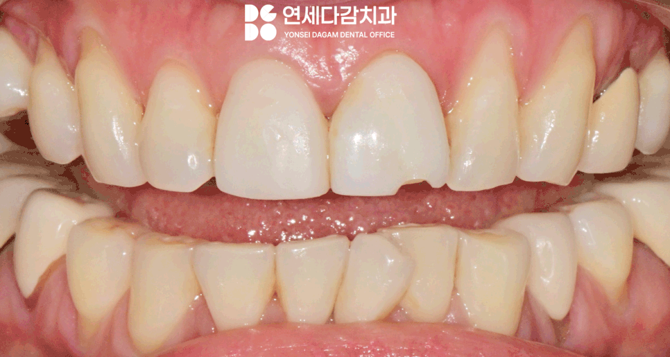 과거와 다르게 앞니 무삭제 라미네이트 가능한 이유 거여역 치과 앞니 보철 깨짐 추가 삭제 없이 재제작 관련 이미지 5