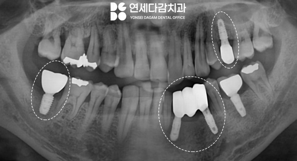 심한 골소실에도 임플란트 가능할까요 가락시장역 치과 뼈이식 통한 안정적인 고정력 확보 과정 관련 이미지 3