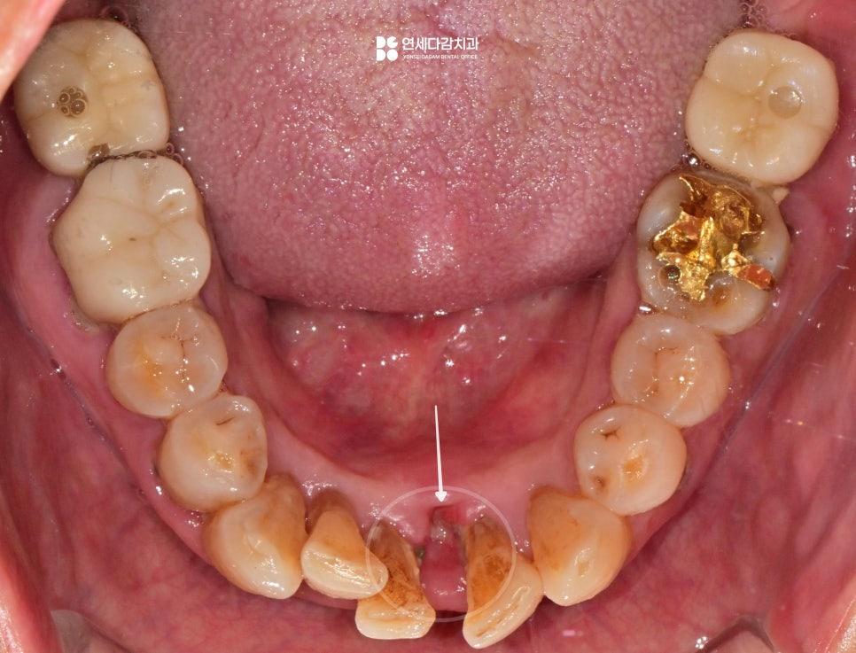 치주염으로 인한 앞니 탈구, 개롱역 치과 에서 설명하는 잠간 고정술 이야기 관련 이미지 2