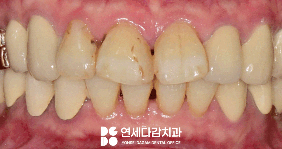 앞니 레진 후 생긴 변색 문제와 삐뚤어진 치아 개롱역 치과 최소삭제 라미네이트 적용할 수 있는 이유 관련 이미지 10