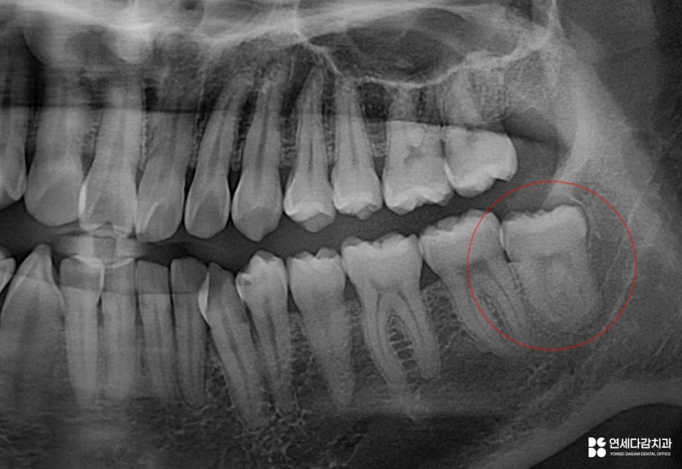 오금역 치과 후방 경사 부분 매복 사랑니, 조기 진단과 안전한 치료를 위한 가이드 관련 이미지 2
