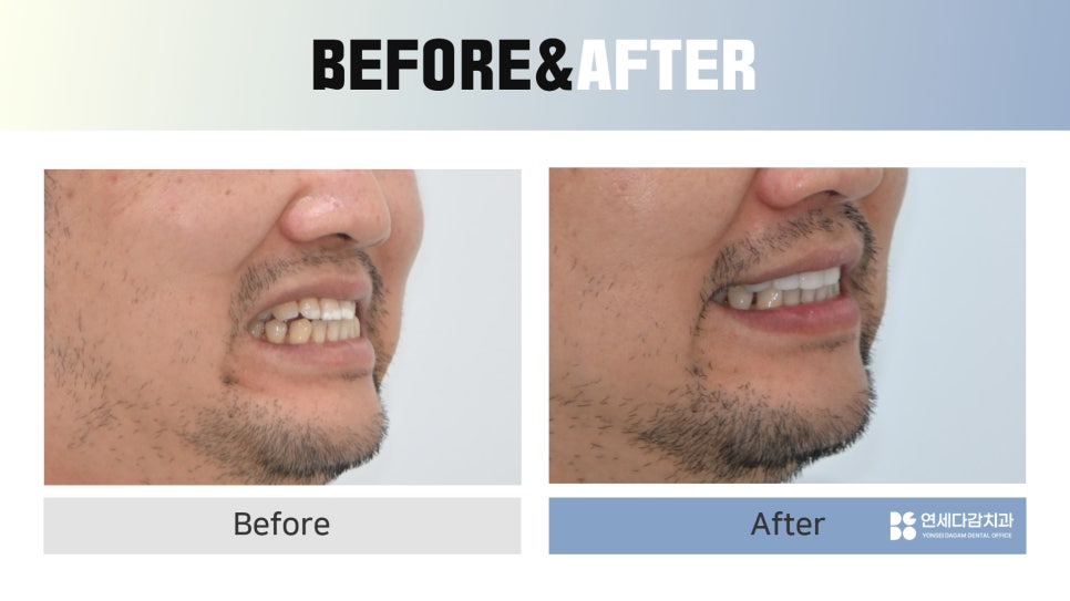 Ogeum-dong Dentist: Want to Improve Front-Tooth Discoloration and Black Triangles at Once with Veneers? <Must-Read> image 8