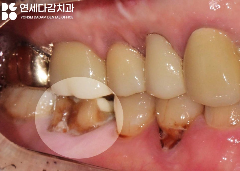 신경치료 후 크라운 떨어짐 원인으로 감염된 충치 치료 미루다 잇몸뼈 녹음 증상 개롱역 치과 발치 후 치근단 낭 적출술 관련 이미지 4