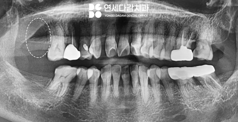 임플란트 재수술 가락동 치과 정밀한 분석과 전략적 접근 통한 치유 과정 관련 이미지 4