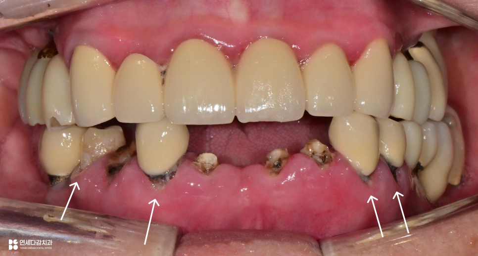 오금역 치과 부분틀니, 예후를 고려한 지대치 평가부터 정밀한 설계까지 중요한 이유 관련 이미지 2