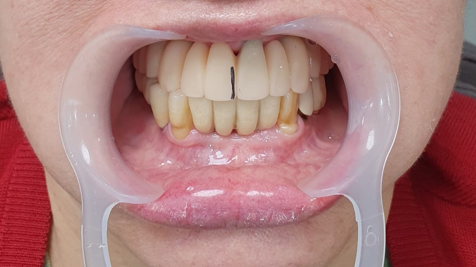 Prosthetics After Implants in Ogeum-dong: Occlusion and Facial Balance Matter Too image 4