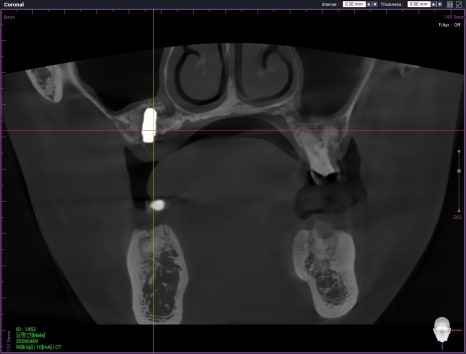 Why a Sinus Lift May Be Needed When There Is Insufficient Bone for Implants in Munjeong-dong image 6