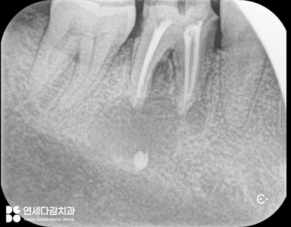 Infection Caused by a Cracked Crown After Root Canal Treatment: Delaying Treatment for Infected Cavities Led to Bone Loss Around the Gums, Garong Station Dental Clinic, Apicoectomy After Extraction image 1