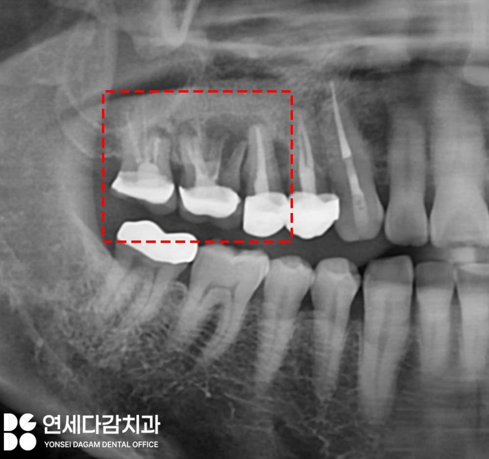 축농증 수술 후에도 임플란트 수술 가능할까? 특별한 송파구 치과 케이스의 해결책 관련 이미지 1