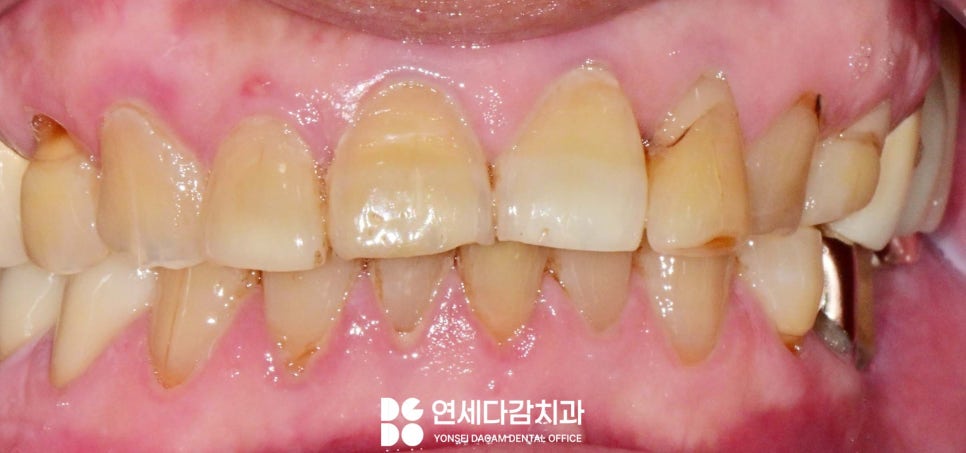 하얀 치아가 가져오는 인상의 변화 오금동 치과 교정 없이 최소삭제 라미네이트 심미치료 통해 치열 및 누렁니 개선 관련 이미지 2