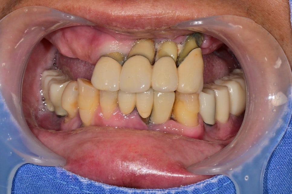 Munjeong-dong Full-Mouth Dental Implants: Why Did the Patient’s Appearance Change After Simply Replacing the Teeth? image 3