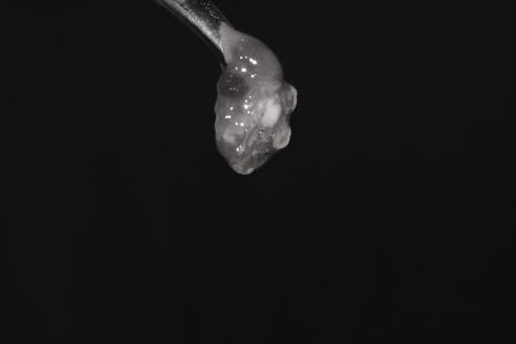 Geoyeo Station Dental Clinic, Mucous Cyst Removal&middot;What If a Lump-Like Bump Protrudes Inside Your Mouth? image 4