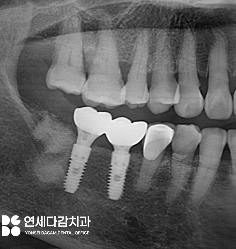오래된 임플란트 다시 수술하지 않고 크라운 교체만 가능할까 문정동 치과 SCRP 타입으로 보철 재제작 관련 이미지 8