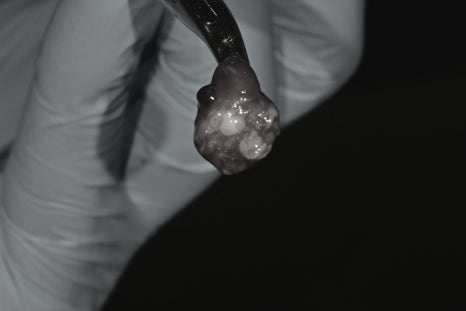 Geoyeo Station Dental Clinic, Mucous Cyst Removal&middot;What If a Lump-Like Bump Protrudes Inside Your Mouth? image 5