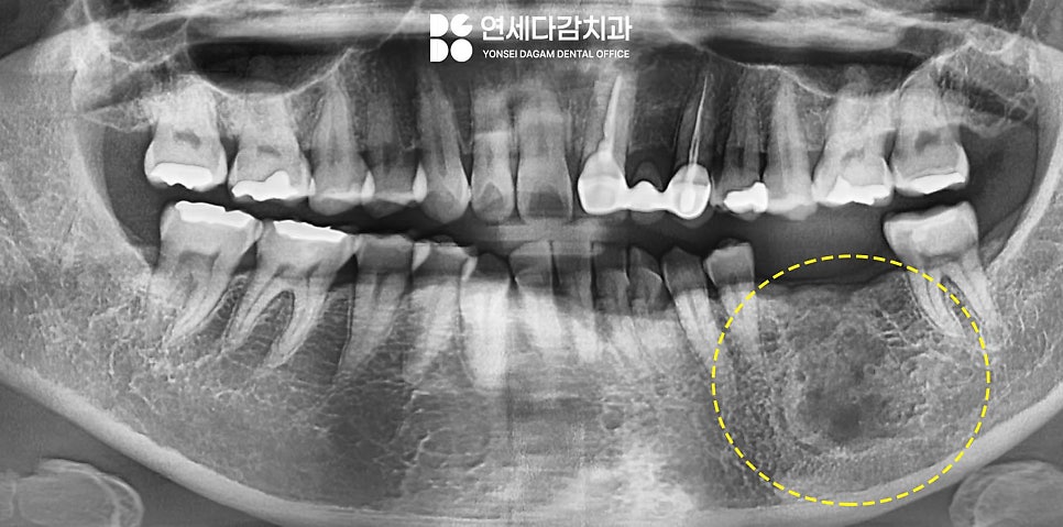 턱뼈에 발생하는 법랑모세포종 거여동 치과 에서 원인과 치료 방법 알려드리겠습니다. 관련 이미지 4