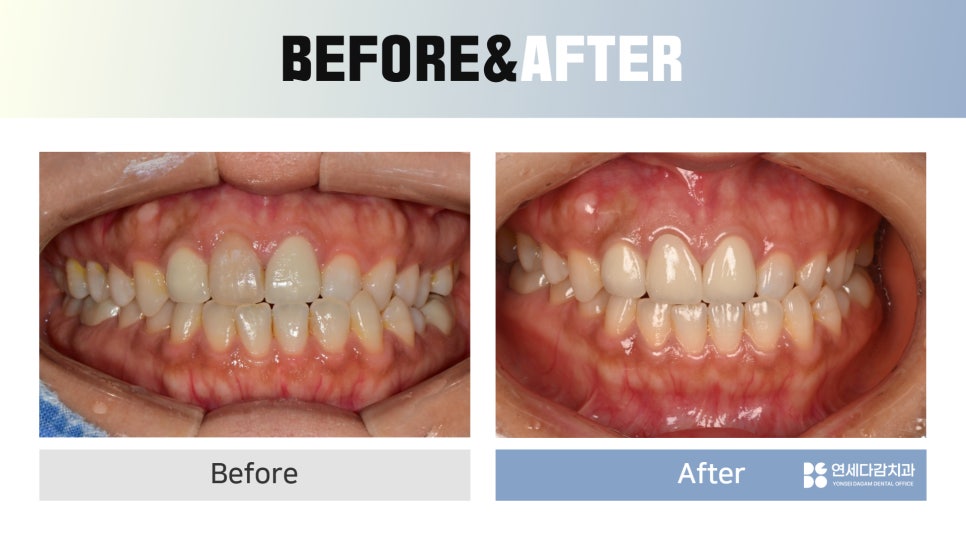 Macheon-dong Dental Clinic: Why Treating Root Inflammation Comes First Before an Anterior Crown image 7
