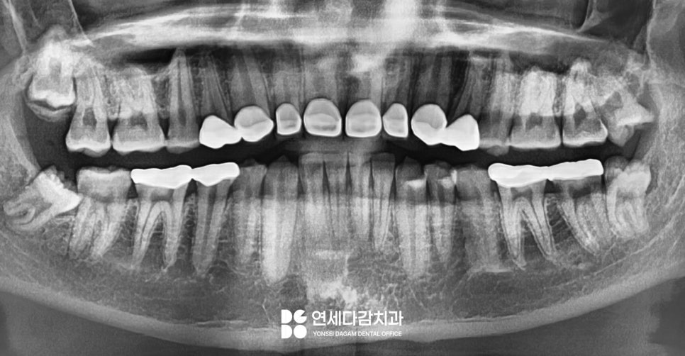 마모로 인한 치아 교모증 문정동 치과 에서 원인과 크라운 치료 방법 알려드리겠습니다. 관련 이미지 7