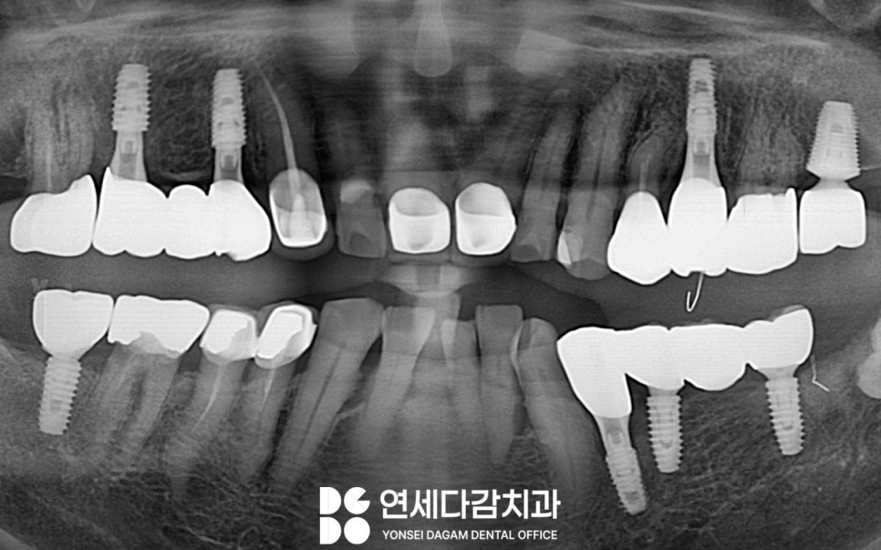 크라운 또는 브릿지 같은 보철 치료 했던 부위에 충치 또는 잇몸질환 생기는 이유 가락시장역 치과 치근우식 생겼을 때 발치 후 임플란트 관련 이미지 7