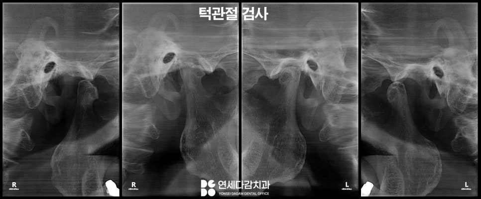 갑자기 얼굴에 찌릿한 날카로운 통증 치아 원인이 아니라면 삼차신경통 의심 문정동 치과 에서 알아보는 치료 방법 관련 이미지 2