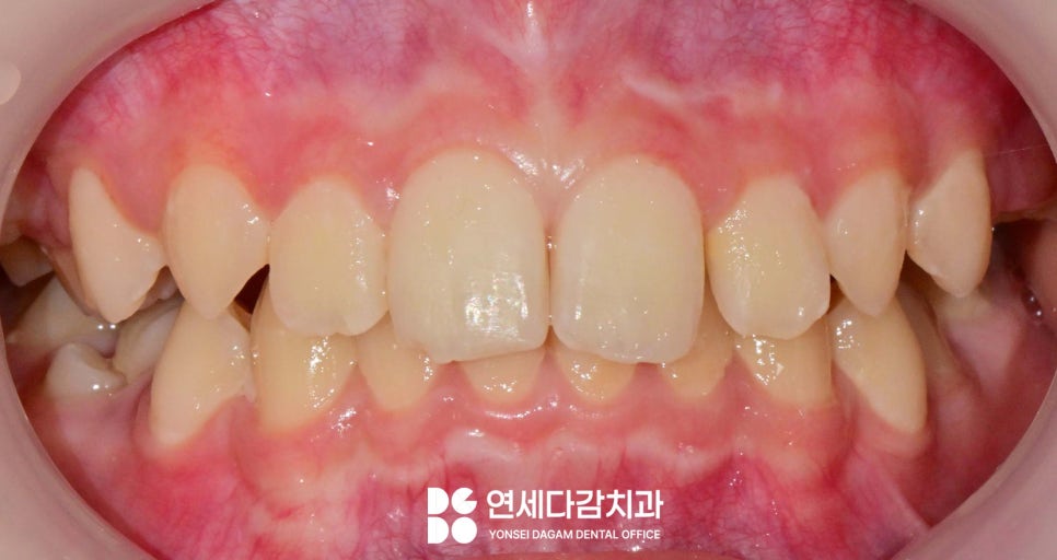 우리 아이 치아 성장 과정 가락시장역 치과 에서 알려주는 소아 유치 빠지는 순서 영구치 나는 시기 관련 이미지 6