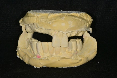 Songpa Station Dentist: Have You Been Using Dentures for a Long Time? <Digital Guided Implants> image 3