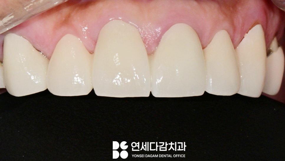 치주염 원인으로 치아 흔들림 오금동 치과 크라운 치료 통해 뻐드러진 앞니 돌출입 해소 과정에서 잇몸치료 필요한 이유 관련 이미지 4