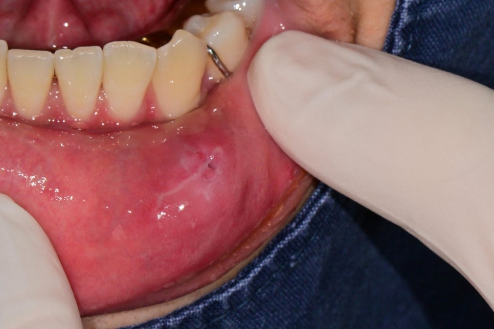 Geoyeo Station Dental Clinic, Mucous Cyst Removal&middot;What If a Lump-Like Bump Protrudes Inside Your Mouth? image 8