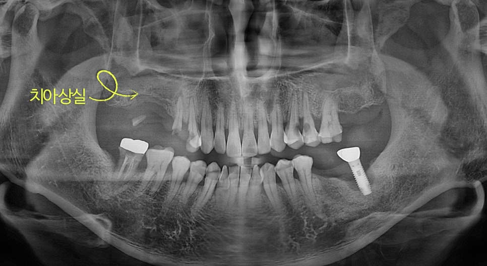 Why a Sinus Lift May Be Needed When There Is Insufficient Bone for Implants in Munjeong-dong image 2