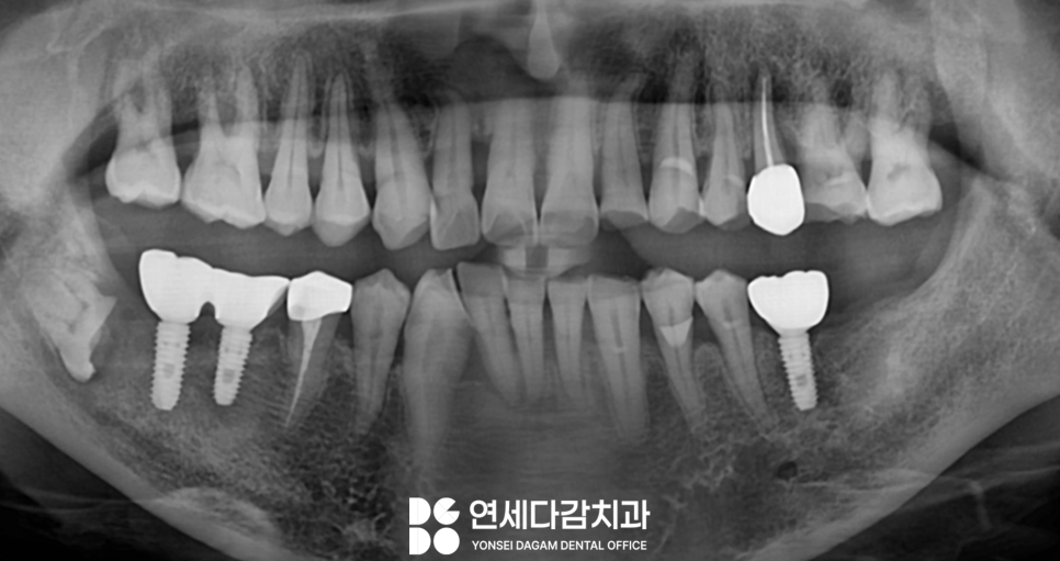 신경과 가까운 매복 사랑니 절반만 잘라서 남긴다고요? 오금역 치과 에서 알려드리는 치관절제술 통한 안전한 발치! 관련 이미지 4