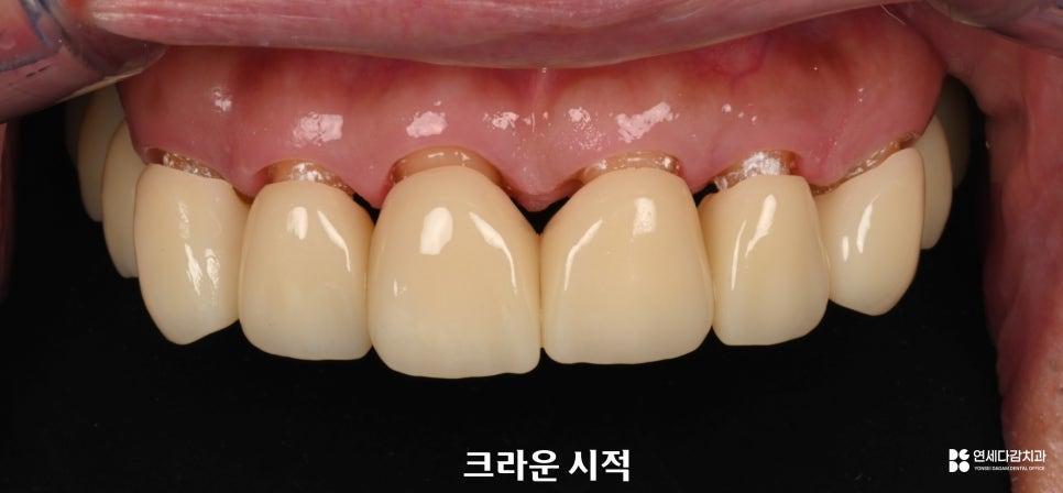 개롱역 치과 뻐드러진 앞니 그리고 치아 틈새 교정 없이 한 번에 해결하는 심미 보철 관련 이미지 5